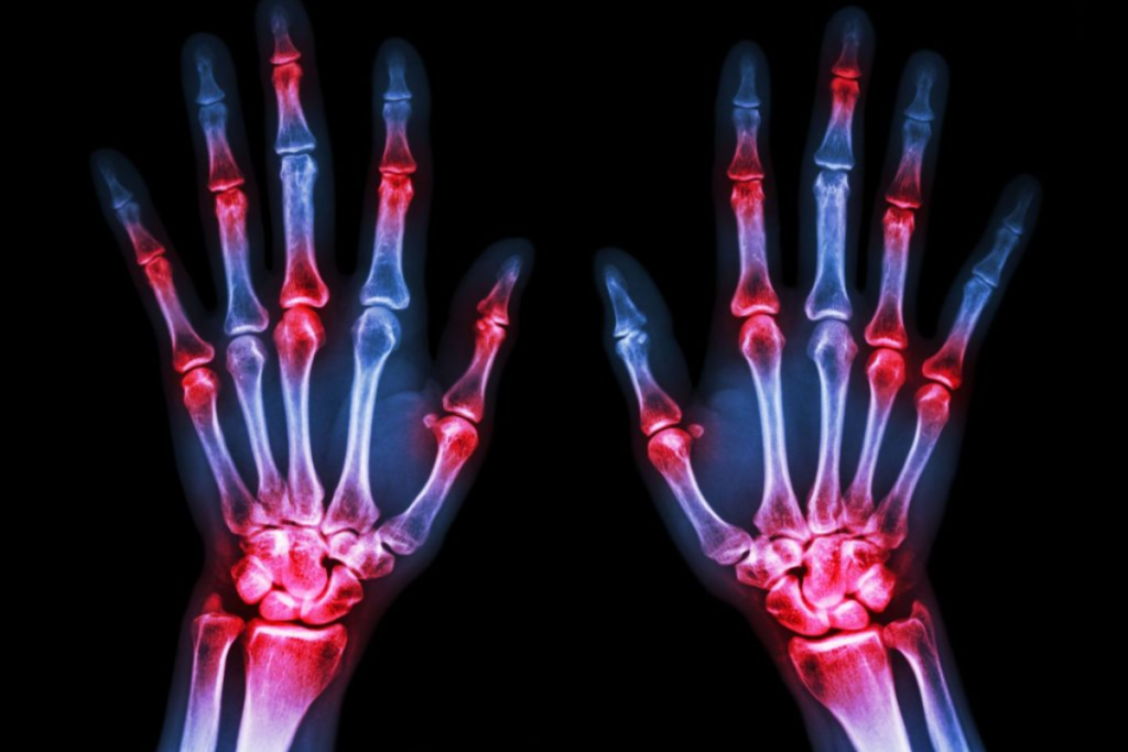 Arthritis myths