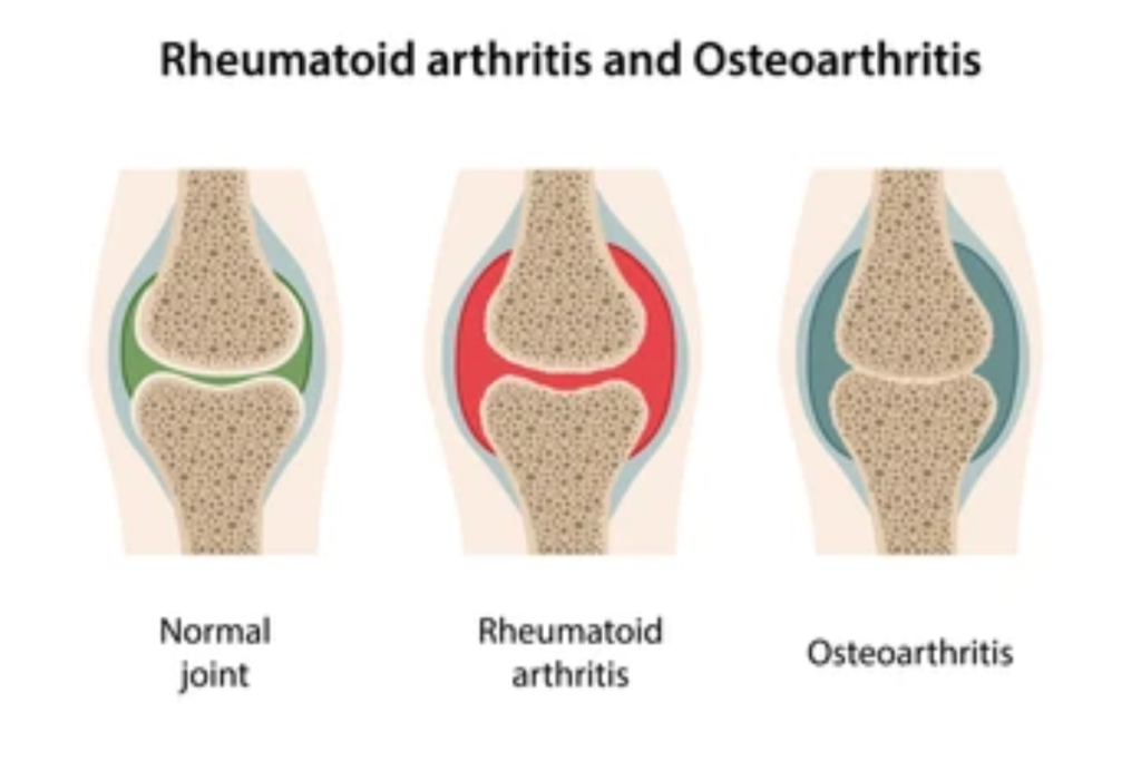 arthritis types